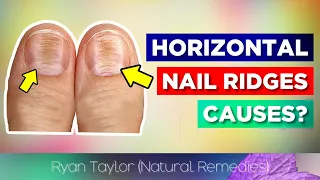 Horizontal Ridges On Nails? (Cause)