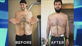 Man Who Lost over 300 Pounds Returns after Skin Removal Surgery