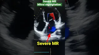 Severe MR ( mitral regurgitation) in Echocardiography #shorts #echo