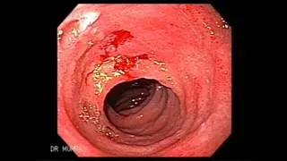 Endoscopy of Celiac Disease