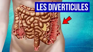 DIVERTICULES ET DIVERTICULITE : Explication et Traitements