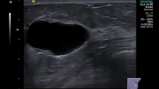 Breast Ultrasound - Cyst