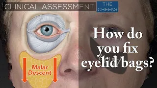 65 yo Female with Lower Eyelid Bags & Periorbital Aging | Aesthetic Minutes #EyelidBags