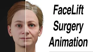 FaceLift Surgery Animation