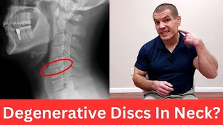 3 Exercises For Cervical Degenerative Disc Disease (Relieve Neck Pain)