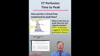 CT Perfusion (CTP) Time to Peak (TTP): CTA & CTP Neuroimaging in Acute Ischemic Stroke Patients 1024