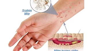 Scabies: Causes, Symptoms and Treatment