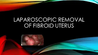 Laparoscopic Myomectomy or Laparoscopic Removal of Fibroids in the Uterus I Dr. Rajeev Agarwal
