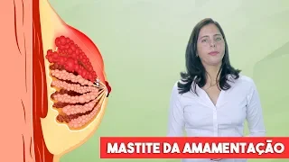 Mastite durante a amamentação (mastite lactacional)