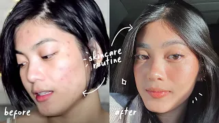 HOW I CLEARED MY ACNE, SCARS, TEXTURE, & HYPERPIGMENTATION FOR GOOD *UNSPONSORED* (ANTI-AGING)