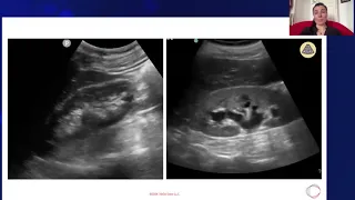 Hydronephrosis vs Normal Kidney