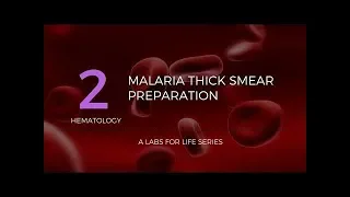 Malaria Thick Smear Preparation