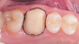Препарирование зубов