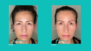 Linda's Upper Blepharoplasty & Brow Lift Experience at Eyesthetica | Los Angeles, CA