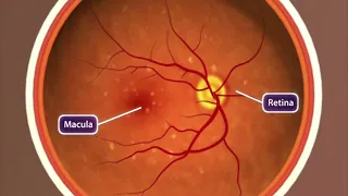 (Audio Description) Animation: Age-related Macular Degeneration