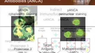 Best Practice for Initiating Therapy for Small Vessel Vasculitis