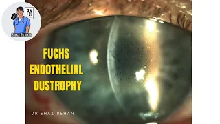 What is Fuchs Endothelial Dystrophy? Eye Dr Explains. 2023.