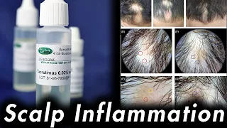 DHT Scalp Inflammation: Tacrolimus and Clobetasol