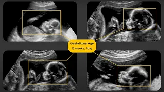 Expanding Ultrasound Access with AI | Google Health