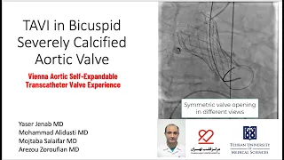 Transcatheter Aortic Valve Replacement (TAVI) in Bicuspid Aortic Valve: Vienna Valve Experience