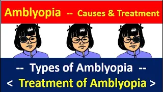 Amblyopia causes and treatment:  causes, types and treatment. #amblyopia #amblyopiatreatment