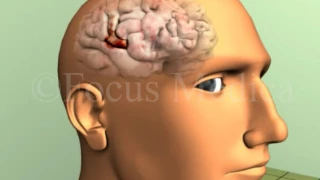 Frontal eye field lesions - Neuroanatomy