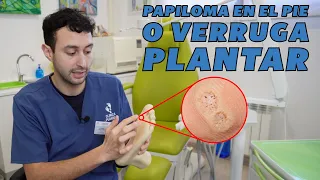 Papiloma en el pie o verruga plantar - Tipología, tratamiento y prevención