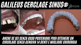 Implantologia senza gengiva chirurgica Galileus Cerclage Sinus®