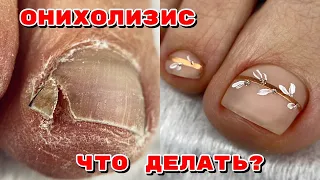 Онихолизис на ногах 😱 Как исправить? Педикюр на клиенте