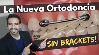 ORTODONCIA SIN BRACKETS: . Tu Ortodoncia más rápida,  Más Estética y Más Cómoda. Carriere Motion