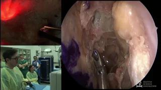 Lab Demo - Prosection: Repair of Skull Base Defects - Brent Senior, MD