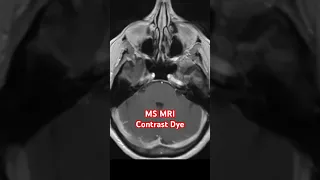 MS MRI Contrast Dye