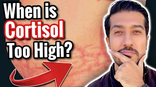 5 Signs of High Cortisol to NOT IGNORE | What Lowers Cortisol?