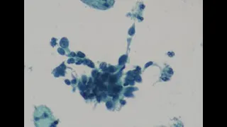 Interesting, Difficult and Unusual Cases in cervical cytology