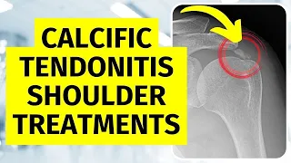 Calcific Tendonitis Shoulder Treatments Without Surgery