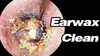 Ear Picking Ears That Have Not Been Cleaned In 20 Years, Earwax Is Very HighASMRearwax