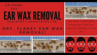 DRY, FLAKEY EAR WAX REMOVAL   EP 365