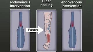 Treating Venous Leg Ulcers