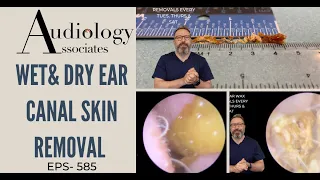 WET & DRY EAR CANAL SKIN REMOVAL - EP585