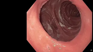 Endoscopic Gastric Bypass Revision (aka TORe): Fast-Forwarded, full-length procedure