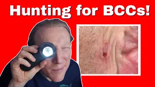 BCC: Basal Cell Carcinoma Skin Cancer: What You NEED to KNOW