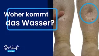 Wasser in den Beinen - Wo kommt das her? | Dr. Heart