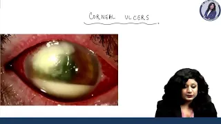 Corneal Ulcers || Dr. Niha Aggarwal