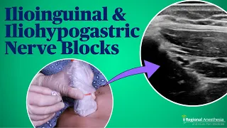 Ultrasound-guided Ilioinguinal and Iliohypogastric Nerve Blocks