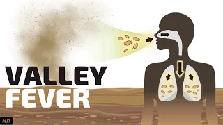 Valley Fever, Causes, Signs and Symptoms, Diagnosis and Treatment.