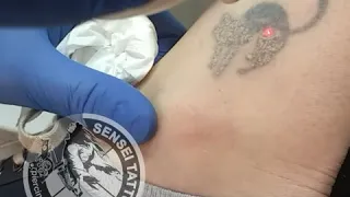 Найти лазерное удаление татуировок в Днепре