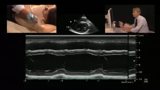 M-Mode Measurement of the Left Ventricle