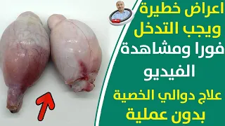 عندك الم في الخصية- طرق علاج دوالي الخصية بدون جراحة بطريقة فعالة ومجربة | اعراض دوالي الخصية