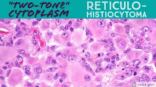 Reticulohistiocytoma & Reticulohistiocytosis: 5-Minute Pathology Pearls for Dermatology & Dermpath