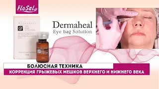 Коррекция грыжевых мешков верхнего и нижнего века препаратом Dermaheal Eyebag Solution